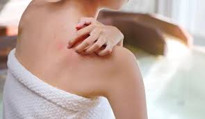 Prurit aquagénique : quand se laver devient inquiétant