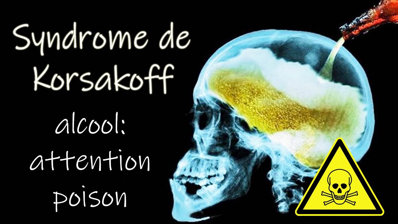Syndrome de Korsakoff :  perte de mémoire d’origine alcoolique !